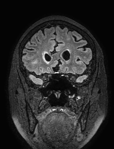 Cavernous hemangioma of the cerebellar falx (Radiopaedia 73025-83724 Coronal FLAIR 99).jpg