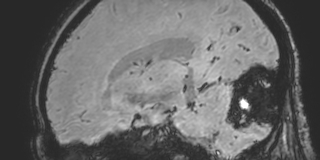 Cavernous hemangioma of the cerebellar falx (Radiopaedia 73025-83724 Sagittal BOLD 81).jpg