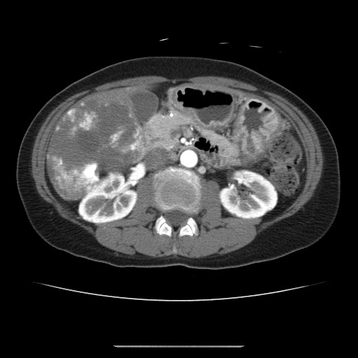 Cavernous hepatic hemangioma (Radiopaedia 75441-86667 A 49).jpg