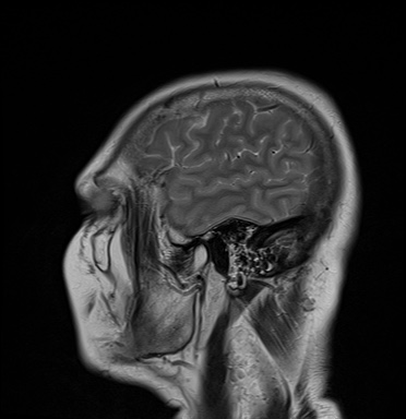 File:Cavernous sinus meningioma (Radiopaedia 63682-72367 Sagittal T2 3).jpg