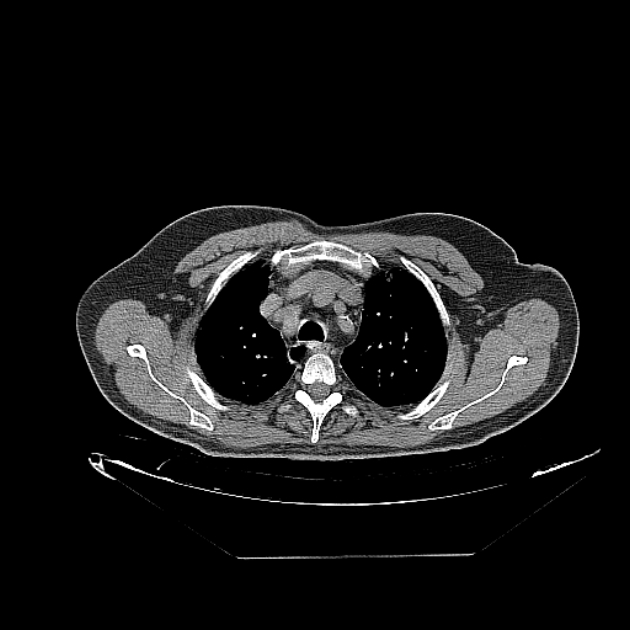 Cavitating bronchogenic carcinoma (Radiopaedia 44489-48162 Axial non-contrast 14).jpg
