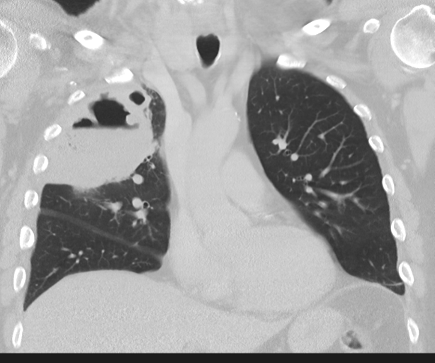Cavitating pneumonia (Radiopaedia 45998-50329 Coronal lung window 21).png
