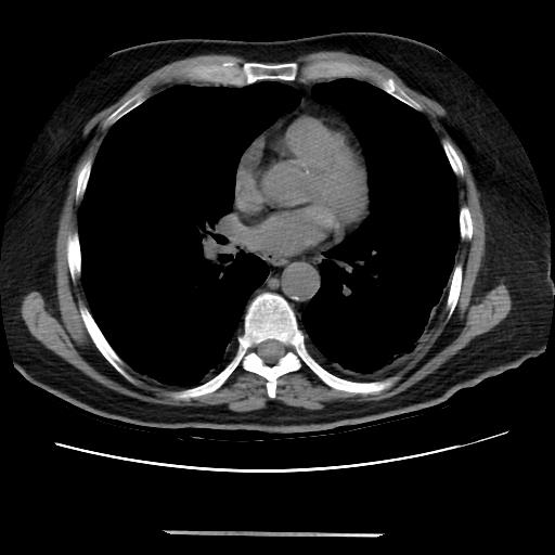 Cavitating pulmonary metastases (Radiopaedia 89545-106544 Axial non-contrast 33).jpg