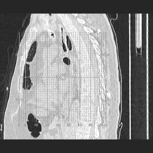 File:Cavitating pulmonary metastases (Radiopaedia 89545-106544 Coronal lung window 1).jpg