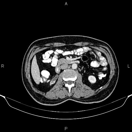 Cecal adenocarcinoma (Radiopaedia 85324-100916 B 42).jpg