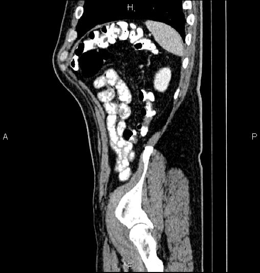 Cecal adenocarcinoma (Radiopaedia 85324-100916 E 79).jpg