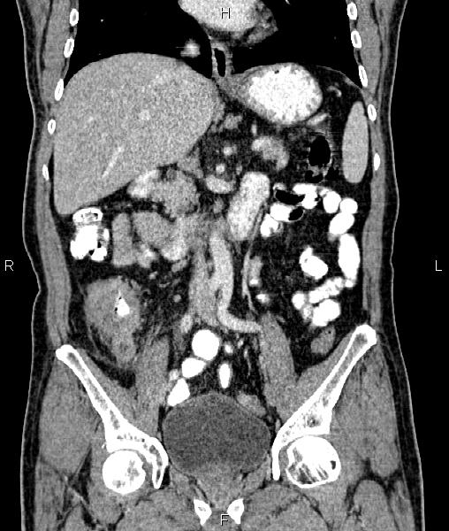Cecal cancer with appendiceal mucocele (Radiopaedia 91080-108651 D 37).jpg