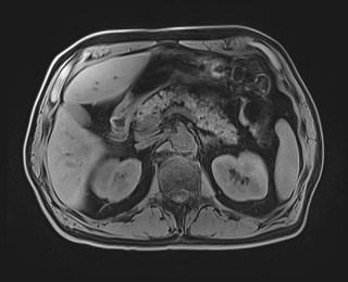 Cecal mass causing appendicitis (Radiopaedia 59207-66532 Axial T1 48).jpg
