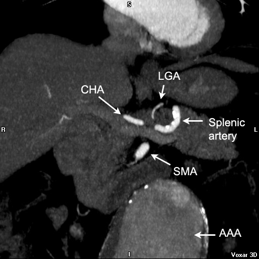 File:Celiac artery anatomy (Radiopaedia 16763-16476 C 1).jpg
