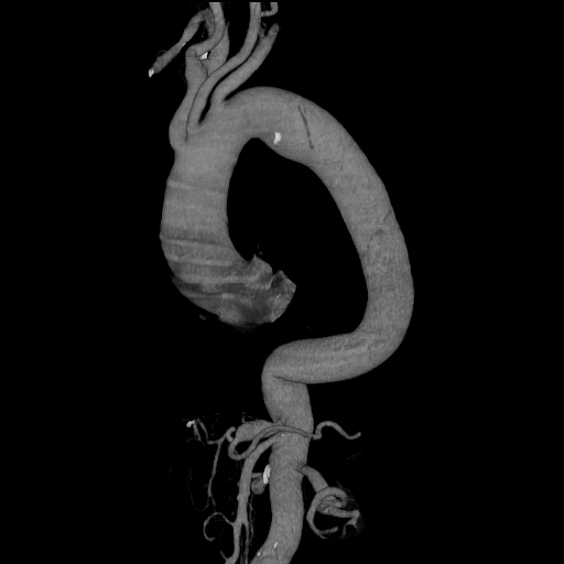 File:Celiac artery aneurysm (Radiopaedia 21574-21525 C 4).JPEG