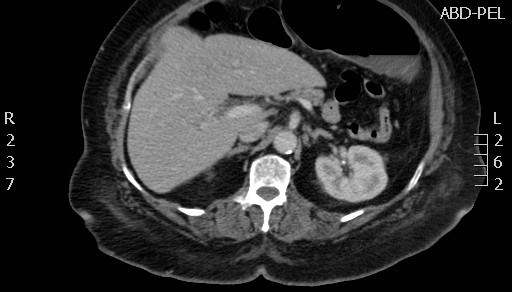 File:Celiac artery compression syndrome (Radiopaedia 24287-24570 B 20).jpg