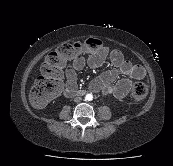 Celiac artery severe stenosis and dissection (Radiopaedia 44128-47842 B 55).jpg