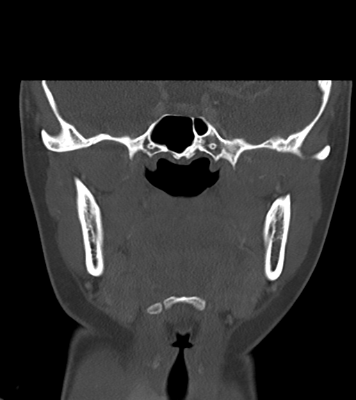 Cemento-ossifying fibroma (Radiopaedia 46243-50643 Coronal bone window 32).png
