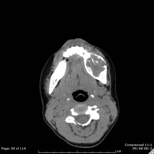 File:Central giant cell granuloma (Radiopaedia 45612-49754 Axial non-contrast 15).jpg