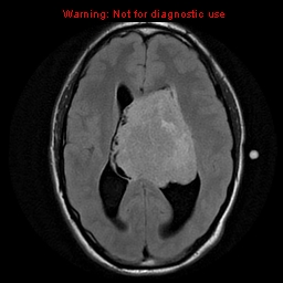 File:Central neurocytoma (Radiopaedia 13188-13206 Axial FLAIR 4).jpg