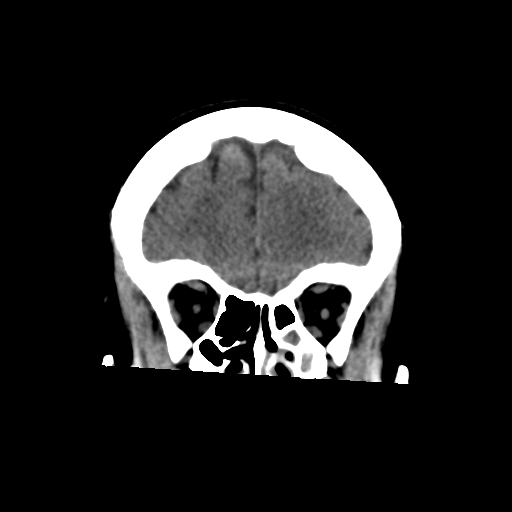 File:Central neurocytoma (Radiopaedia 65317-74346 Coronal non-contrast 15).png