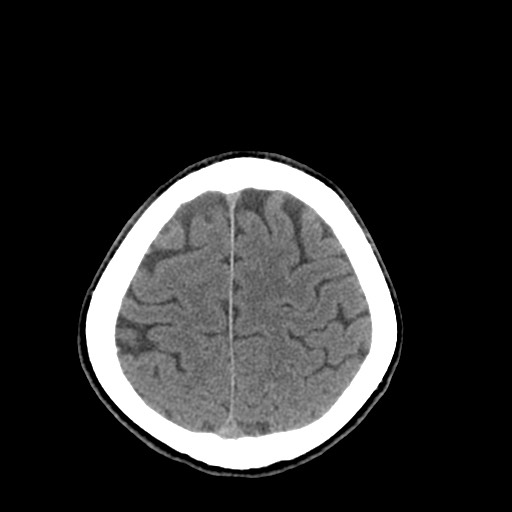 Central neurocytoma (Radiopaedia 68725-78432 Axial non-contrast 45).jpg