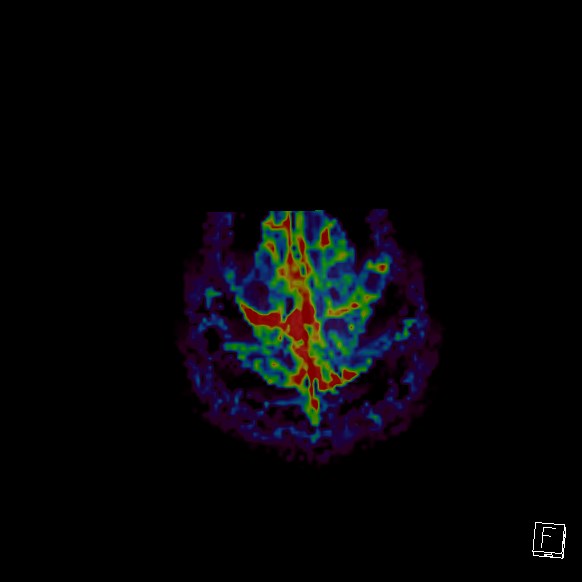 Central neurocytoma (Radiopaedia 84497-99872 Axial Perfusion 15).jpg