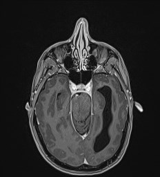 Central neurocytoma (Radiopaedia 84497-99872 Axial T1 C+ 56).jpg