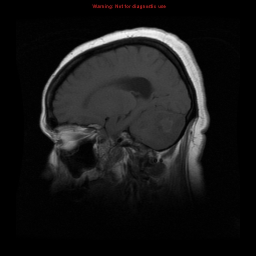 File:Cerebellar abscess (Radiopaedia 10845-11275 Sagittal T1 1).jpg