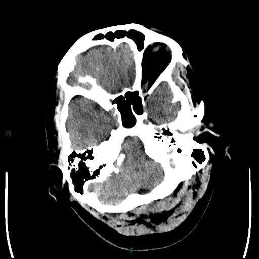 Cerebellar abscess (Radiopaedia 78135-90671 Axial non-contrast 23).jpg