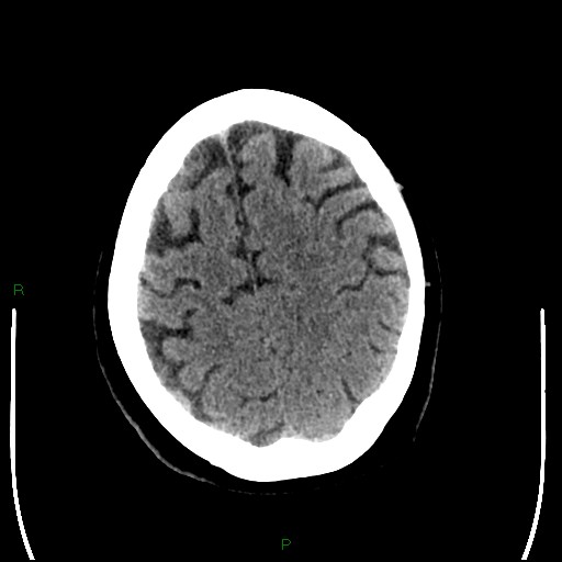 Cerebellar abscess (Radiopaedia 78135-90671 Axial non-contrast 86).jpg