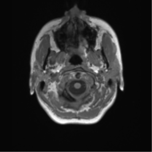 Cerebellar agenesis with hypoplastic pons (pontocerebellar hypoplasia) (Radiopaedia 57224-64138 Axial T1 7).png