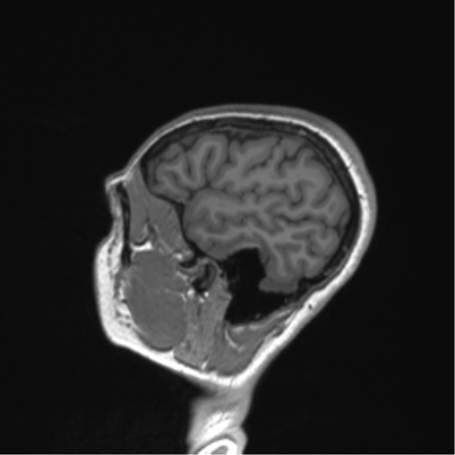 Cerebellar agenesis with hypoplastic pons (pontocerebellar hypoplasia) (Radiopaedia 57224-64138 Sagittal T1 17).png