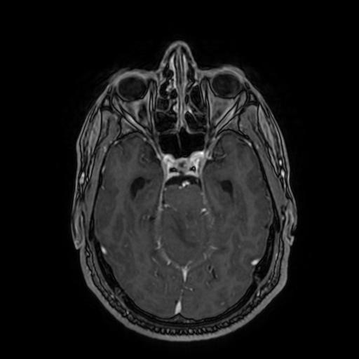 Cerebellar hemangioblastoma (Radiopaedia 88055-104622 Axial T1 C+ 73).jpg