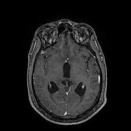 Cerebellar hemangioblastoma (Radiopaedia 88055-104622 Axial T1 C+ 90).jpg