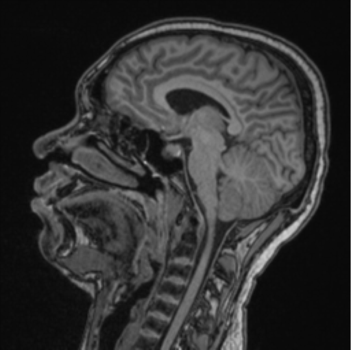 Cerebellar hemangioblastomas and pituitary adenoma (Radiopaedia 85490-101176 Sagittal T1 50).png