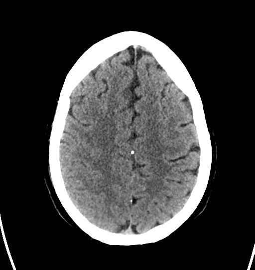 File:Cerebellar infarct due to vertebral artery dissection with posterior fossa decompression (Radiopaedia 82779-97031 Axial non-contrast 24).png