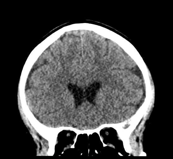 Cerebellar metastases - colorectal adenocarcinoma (Radiopaedia 40947-43652 Coronal non-contrast 34).png