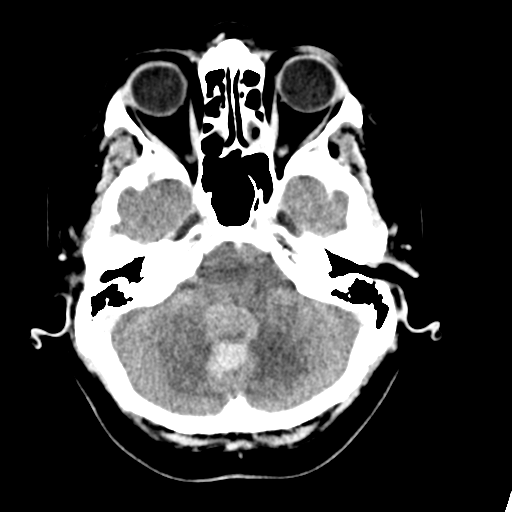 Cerebellar metastasis (Radiopaedia 54578-60812 Axial C+ 11).png