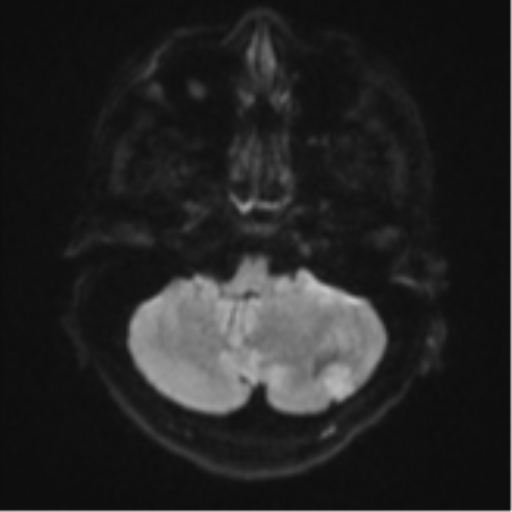 Cerebellar metastasis - adenocarcinoma lung (Radiopaedia 63184-71715 Axial DWI 34).png
