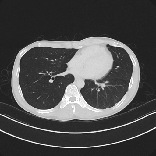 Cerebellar metastasis - adenocarcinoma lung (Radiopaedia 63184-71717 Axial lung window 44).png