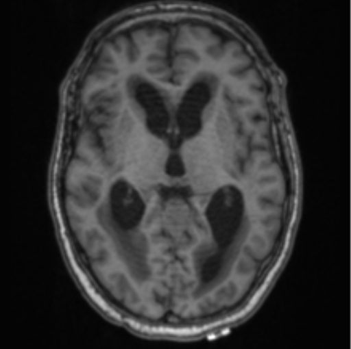 Cerebellar metastasis from lung adenocarcinoma (Radiopaedia 86690-102829 Axial T1 41).png