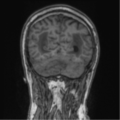 Cerebellar metastasis from lung adenocarcinoma (Radiopaedia 86690-102829 Coronal T1 24).png