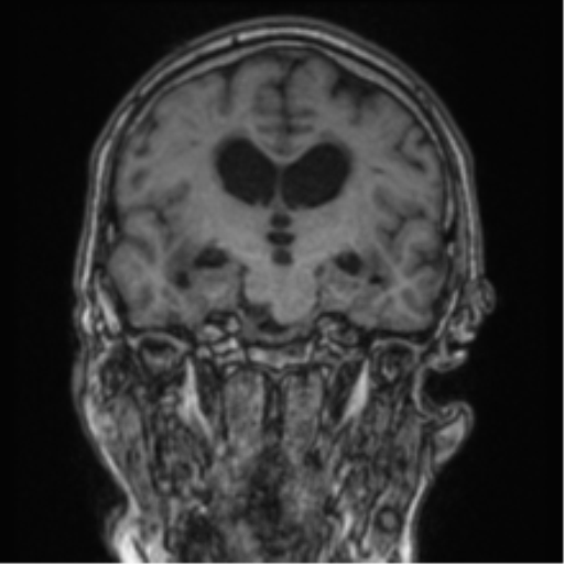 Cerebellar metastasis from lung adenocarcinoma (Radiopaedia 86690-102829 Coronal T1 54).png