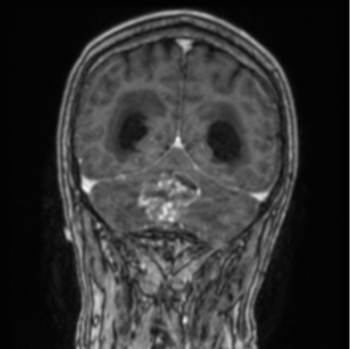 Cerebellar metastasis from lung adenocarcinoma (Radiopaedia 86690-102829 Coronal T1 C+ 29).png