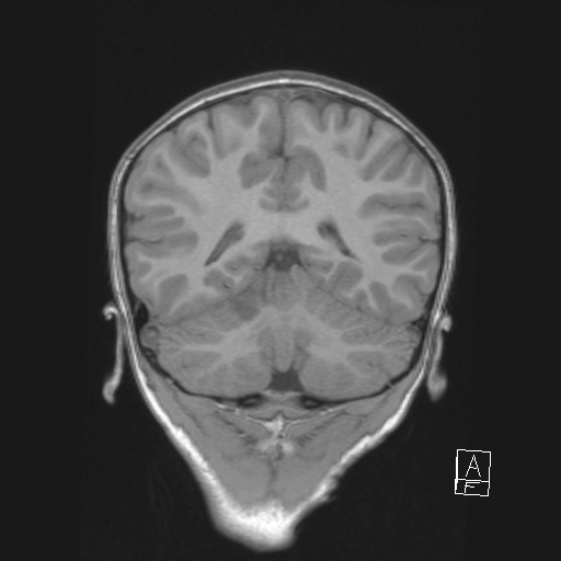 File:Cerebellar stroke (Radiopaedia 32202-33150 Coronal T1 42).png