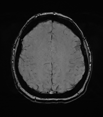 File:Cerebellopontine angle meningioma (Radiopaedia 48434-53348 Axial SWI 67).png