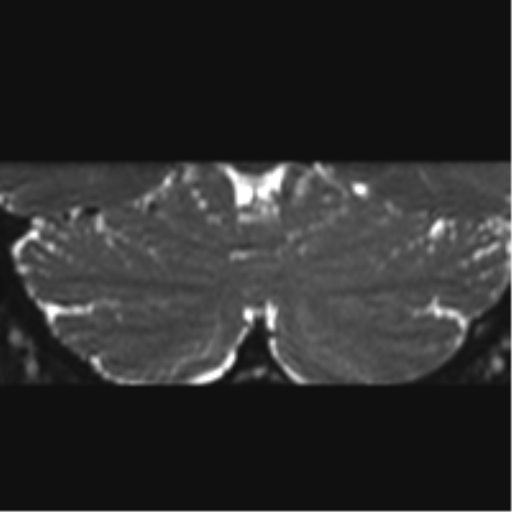 Cerebellopontine angle meningioma (Radiopaedia 48434-53348 Coronal T2 5).png