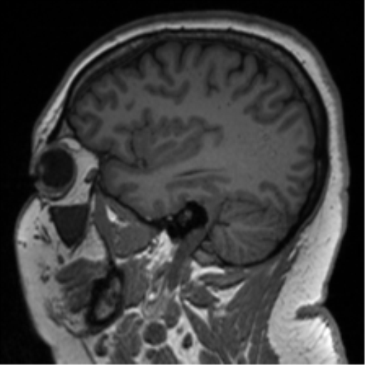 Cerebellopontine angle meningioma (Radiopaedia 48434-53348 Sagittal T1 28).png