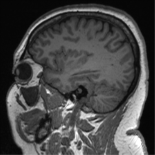Cerebellopontine angle meningioma (Radiopaedia 48434-53348 Sagittal T1 29).png