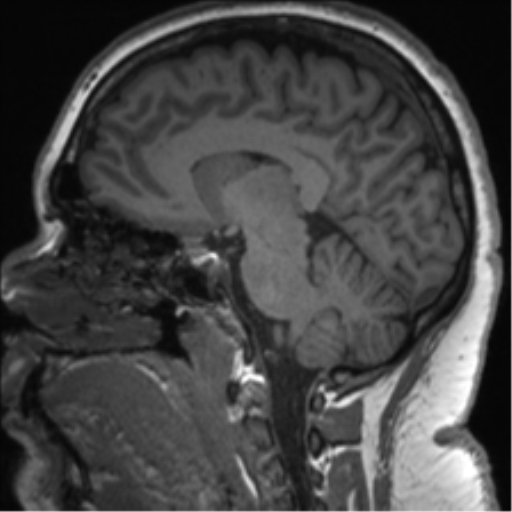 File:Cerebellopontine angle meningioma (Radiopaedia 48434-53348 Sagittal T1 43).png