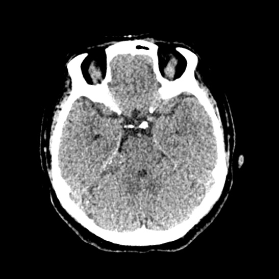 Cerebellopontine angle meningioma (Radiopaedia 53561-59592 Axial non-contrast 23).jpg