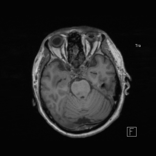 Cerebral abscess (Radiopaedia 26111-26247 Axial T1 24).jpg
