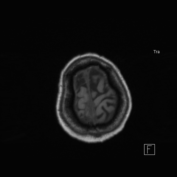 Cerebral abscess (Radiopaedia 26111-26247 Axial T1 50).jpg