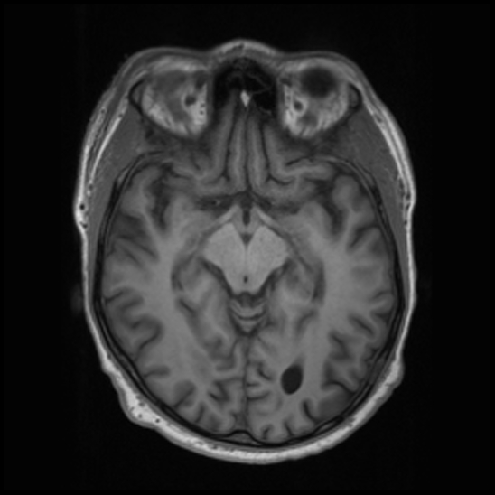 File:Cerebral abscess with ventriculitis (Radiopaedia 78965-91878 Axial T1 21).jpg
